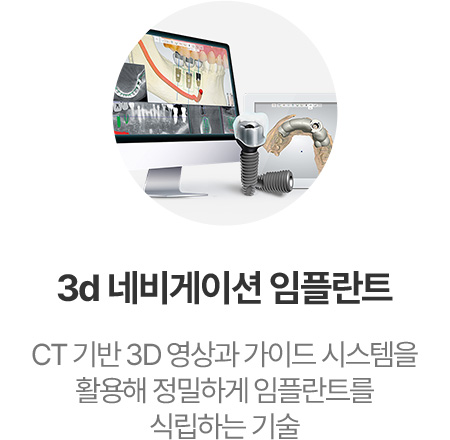 3d 네비게이션 임플란트