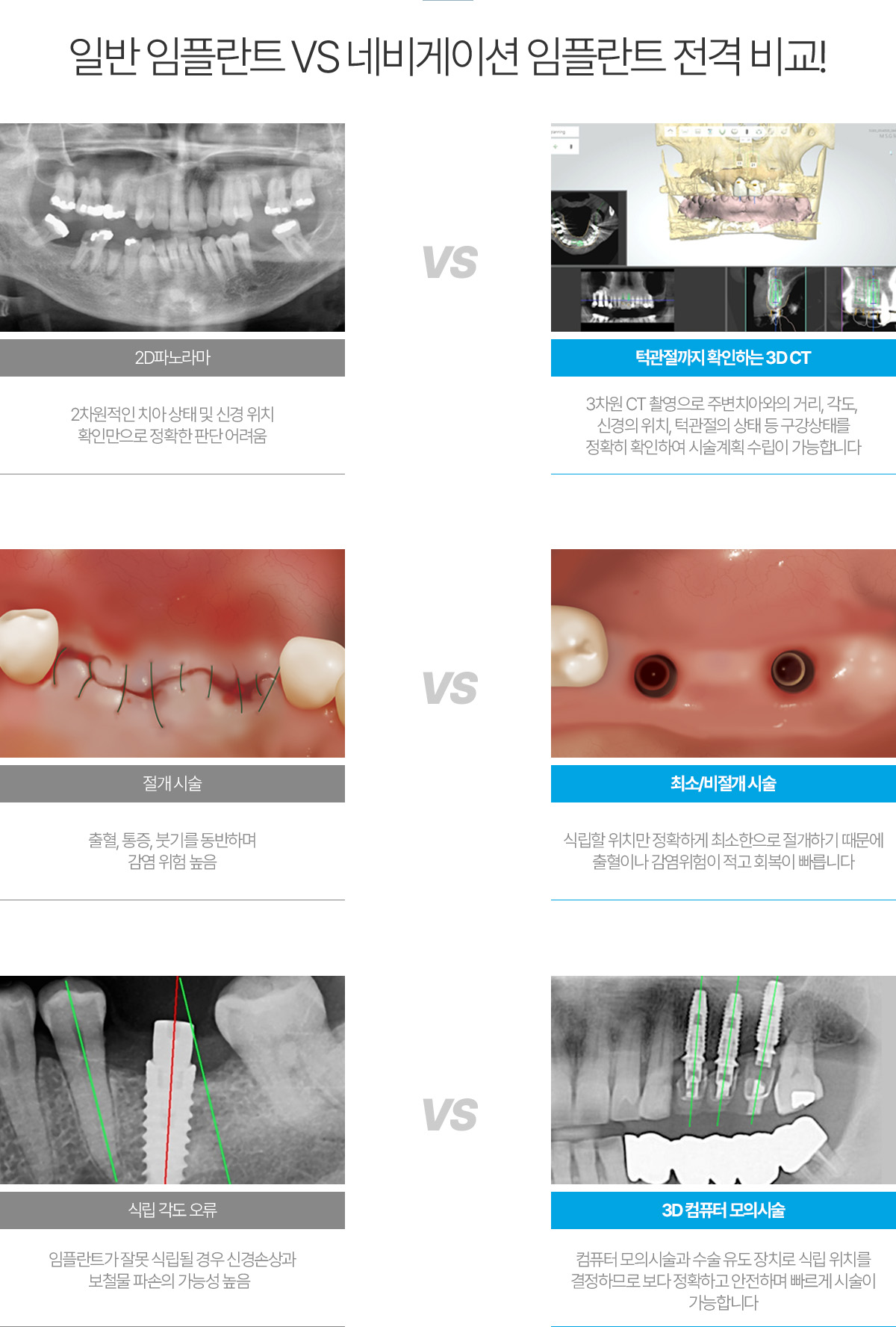 일반 임플란트 VS 네비게이션 임플란트 전격 비교!