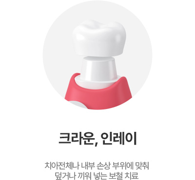 크라운, 인레이