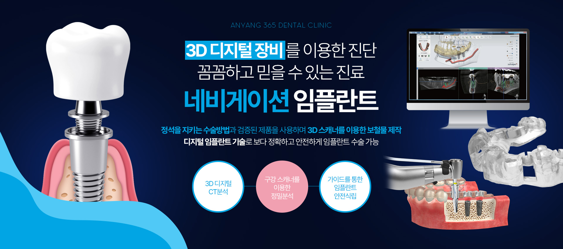 네비게이션 임플란트